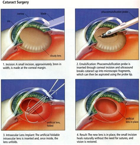 cataract surgery huddersfield|Cataract Surgery .